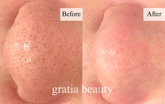 フェイシャル施術例1