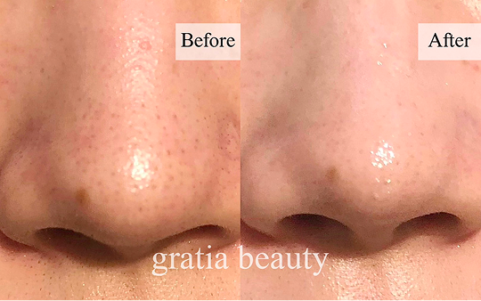 フェイシャル施術例2