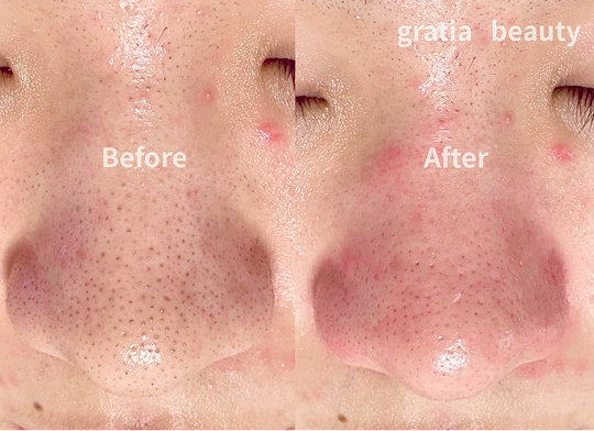 フェイシャル施術例4