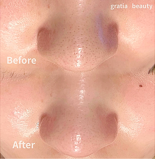 フェイシャル施術例5