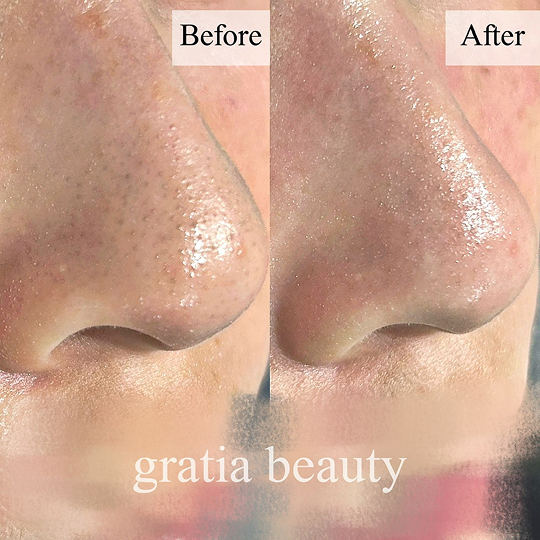 フェイシャル施術例6