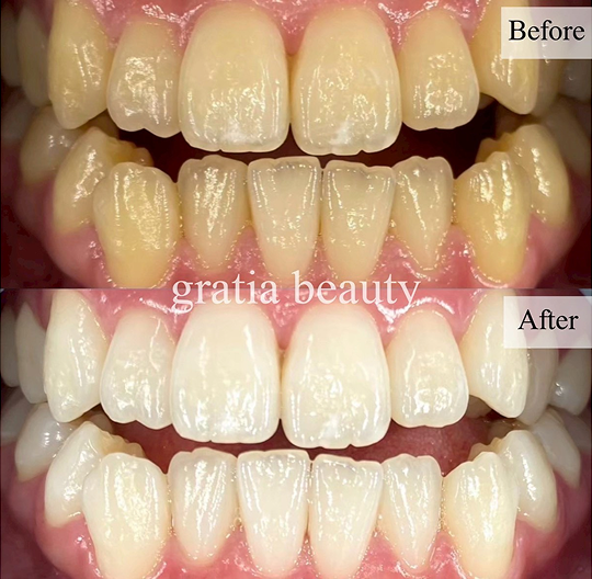 ホワイトニング施術例1