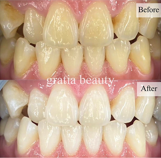 ホワイトニング施術例2