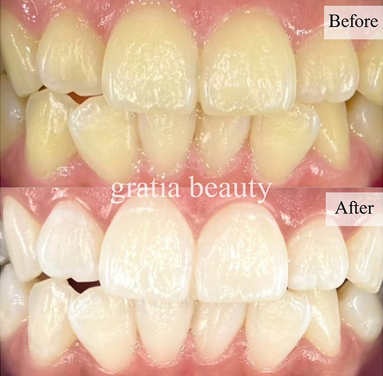ホワイトニング施術例3