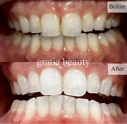 ホワイトニング施術例4